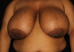 Breast Reduction - Case #1 Before